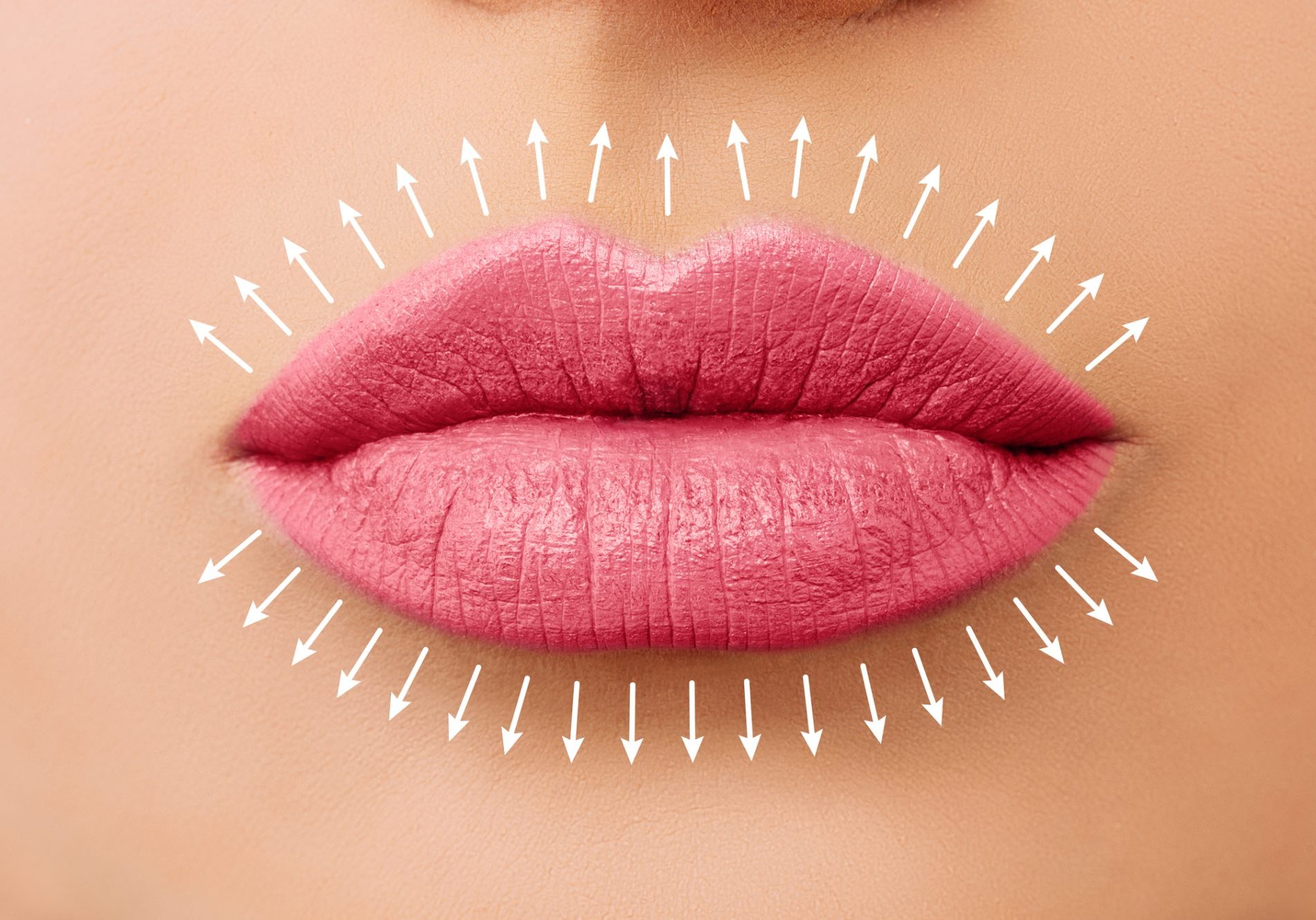 lip filler